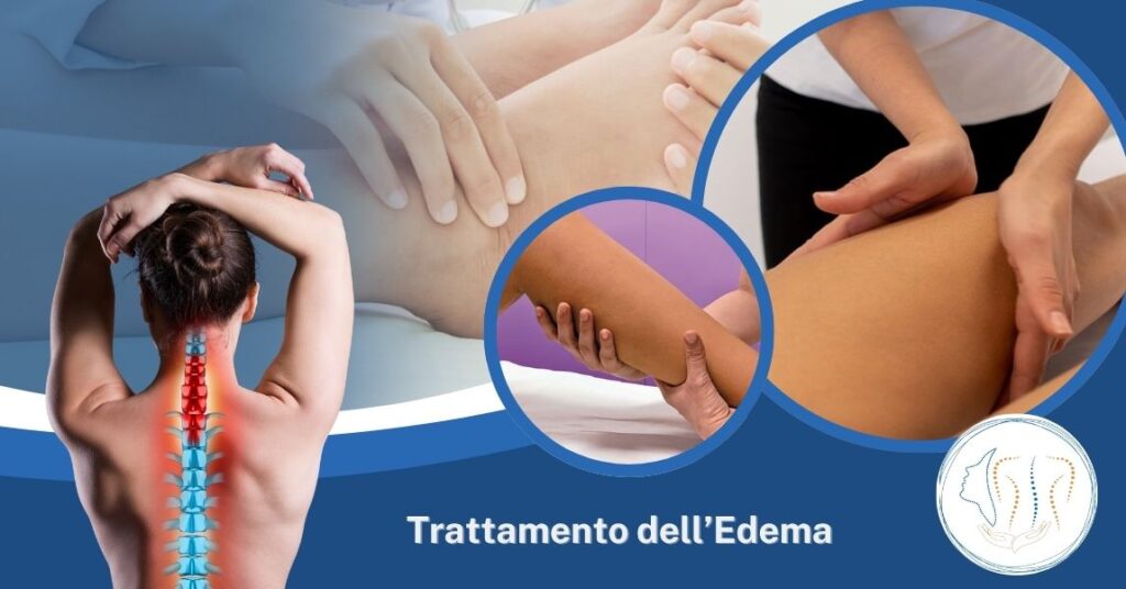 Massofisioterapista per il trattamento dell’edema linfatico ad Ancona da Paladini Simona Massofisioterapista